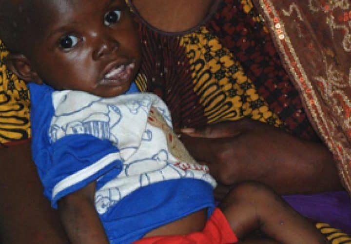 Enfant touché par la malnutrition au Mali, illustrant l'urgence sanitaire
